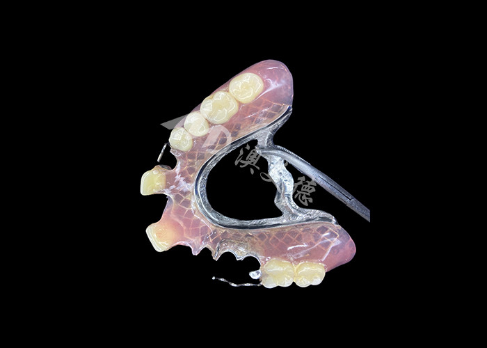 Protesi parziali cast per la precisione, la durata e il comfort nella sostituzione parziale dei denti