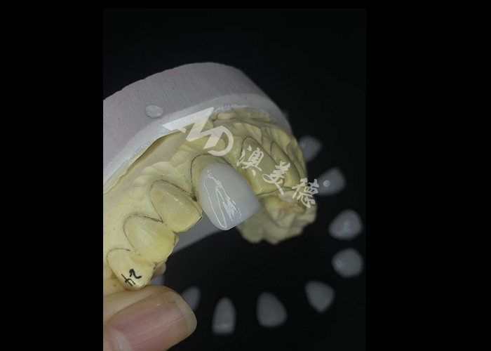 Veneers IPS e.max di precisione per trasformazioni senza rivali del sorriso che offrono un'estetica di durata eccezionale