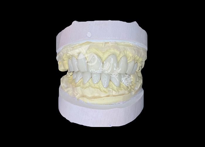 Veneers IPS e.max di precisione per trasformazioni senza rivali del sorriso che offrono un'estetica di durata eccezionale