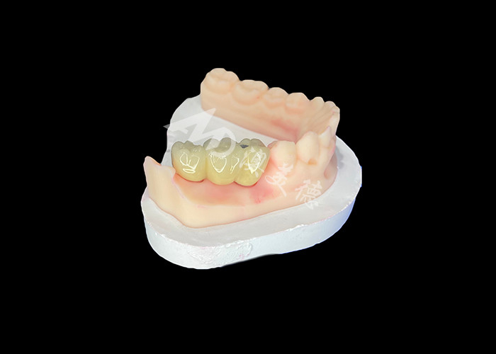 Le corone dentali PFM sono realistiche e resistenti alla corrosione per una salute orale ottimale