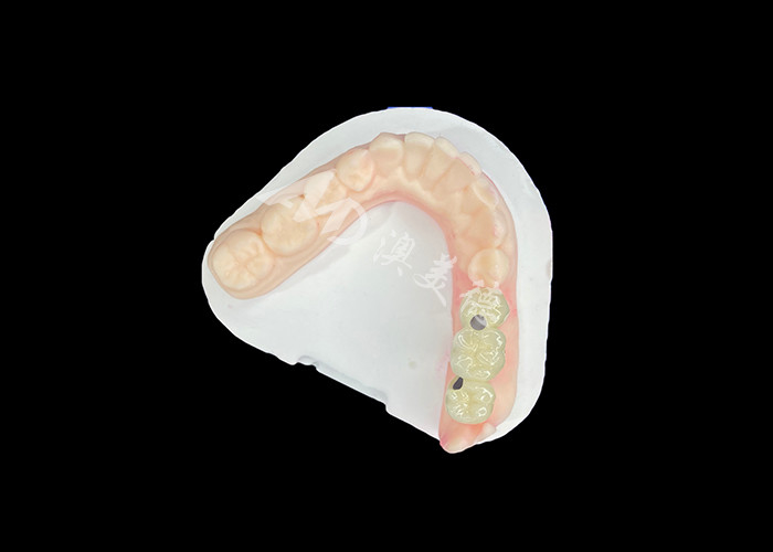 Le corone dentali PFM sono realistiche e resistenti alla corrosione per una salute orale ottimale
