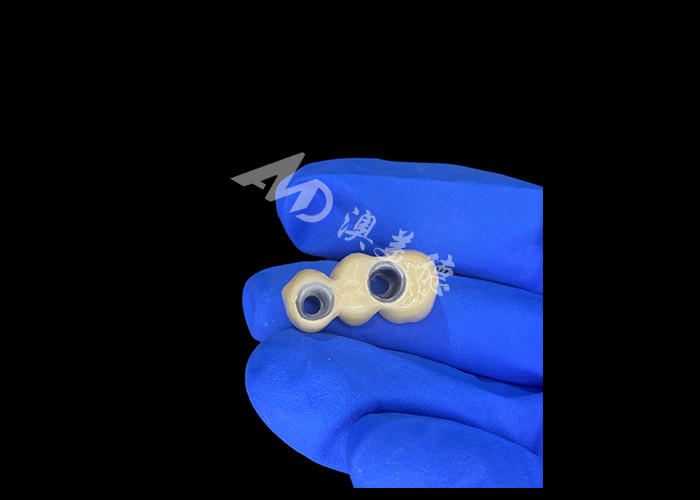 Le corone dentali PFM sono realistiche e resistenti alla corrosione per una salute orale ottimale