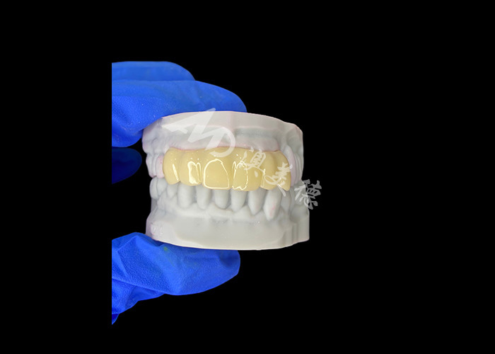 Ponte temporaneo cavo stampato in 3D leggero e biocompatibile per ripristino pre-impianto