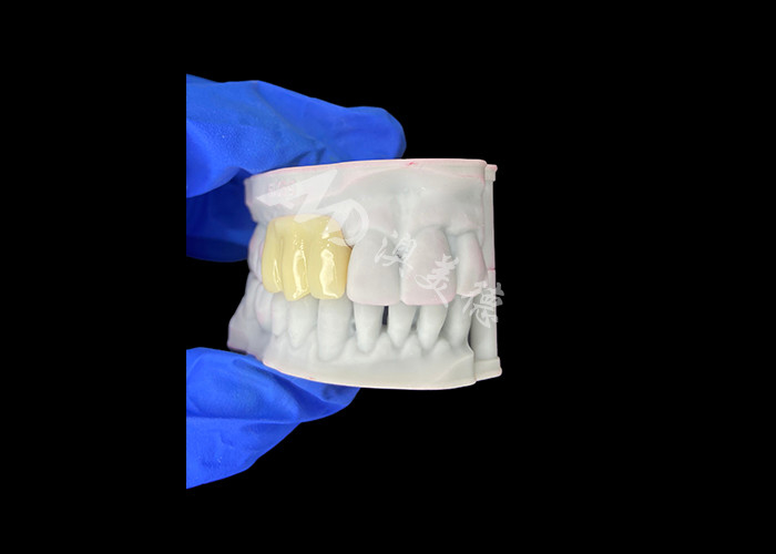 Ponte temporaneo cavo stampato in 3D leggero e biocompatibile per ripristino pre-impianto