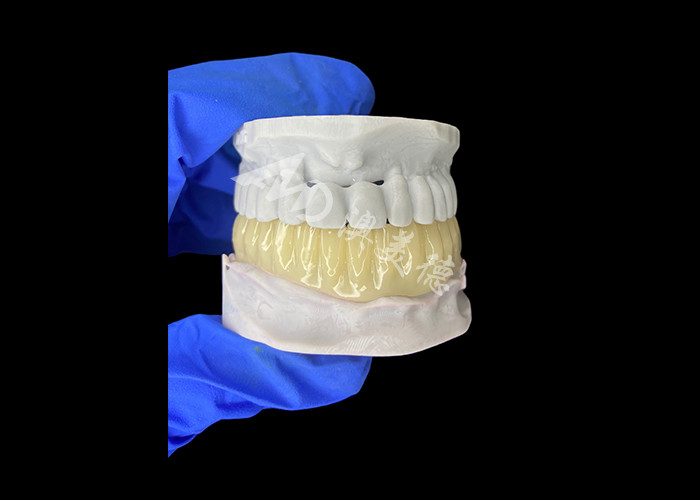 Ponte temporaneo cavo stampato in 3D leggero e biocompatibile per ripristino pre-impianto