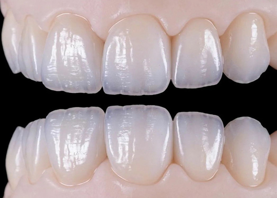 Buon prezzo Ponte di corona dentale in ceramica naturale resistente all'usura per un restauro realistico in linea