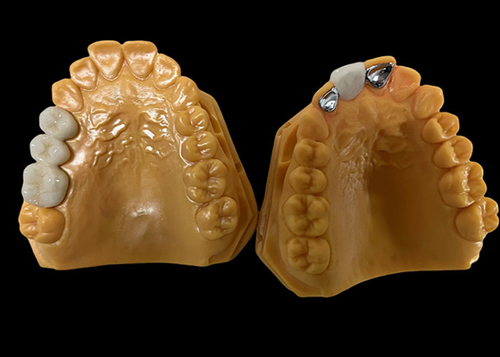 Buon prezzo Porcellana di trasparenza moderata fusa al metallo corona PFM, corona ceramica PFM in linea