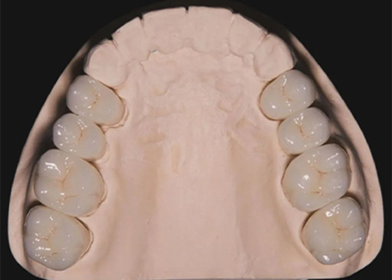 Buon prezzo Restauro dentale denti circonia corone dentali realizzate da laboratorio dentale in Cina in linea