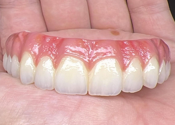 Buon prezzo Salubrità orale Impianto dentale Protesi protesi a supporto Superficie lucidata ponte Protesi a supporto protesi complete in linea