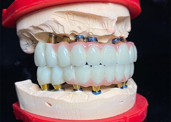 Buon prezzo Impianto dentale a base di titanio lucidato Ponte corona in ceramica per la restaurazione dentale in linea