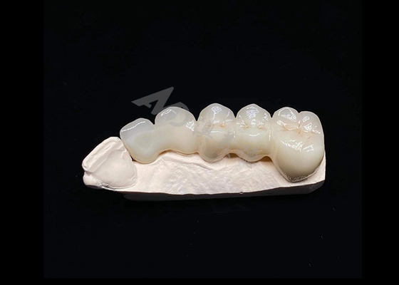 Buon prezzo Traslucidità Estetica naturale Corona di zirconia solida per denti Resistente ai frammenti in linea