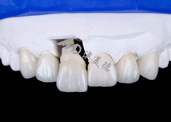 Buon prezzo Corona di impianto dentale con supporto in titanio per sorrisi naturali in linea