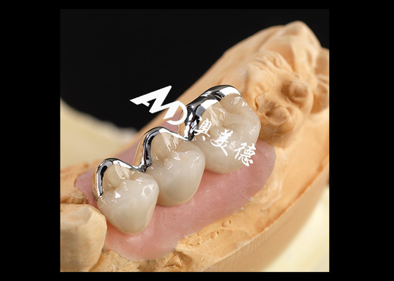 Buon prezzo Forte porcellana PFM fusa con corona metallica eccellente biocompatibilità resistenza all'usura in linea