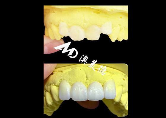 Buon prezzo Corone dentali in zirconia traslucida realizzate da AMD Dental Lab in linea