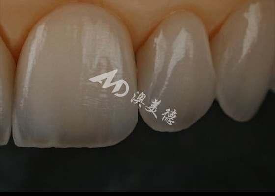 Buon prezzo Resistenza ai frantumi Corona dentale in zirconia per denti anteriori / denti posteriori in linea