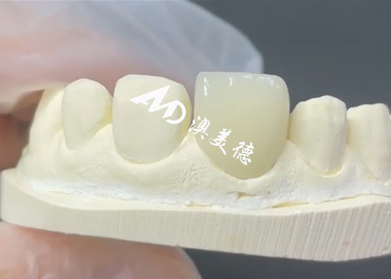Buon prezzo Veneer EMAX durevole ed estetico La soluzione perfetta per i restauri di porcellane in linea