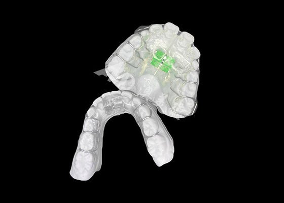 Buon prezzo Un efficace espansore ortodontico rimovibile per un allineamento ottimale della mascella e la salute dentale in linea
