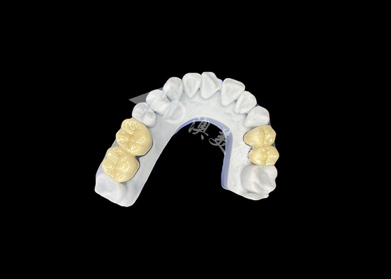 Buon prezzo Circonia PFZ corona dentale in porcellana dal laboratorio dentale cinese professionale in linea