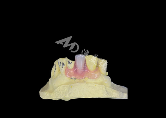 Buon prezzo Protesi parziale flessibile Nesbit per comfort e durata nella sostituzione dei denti in linea