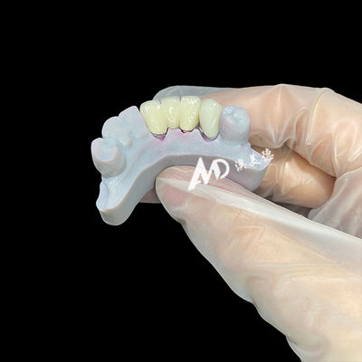 Buon prezzo Corona dentale in zirconia con nucleo di post metallo che offre un'estetica dall'aspetto naturale, un adattamento preciso e una biocompatibilità superiore in linea