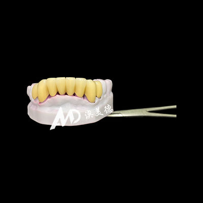 Buon prezzo Corona dentale in zirconio resistente con perno metallico per un restauro dentale forte e dall'aspetto naturale in linea