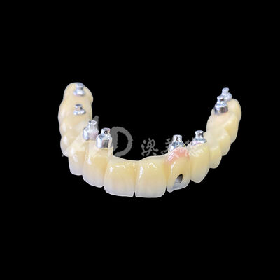Buon prezzo Ponte Implanto-Supportato in Metallo-Ceramica (PFM) a Ritenzione Viti in linea
